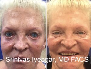 Eyelid Surgery Complications d74a80c7 ee5c 41dd ae4c 6e42e4087f63