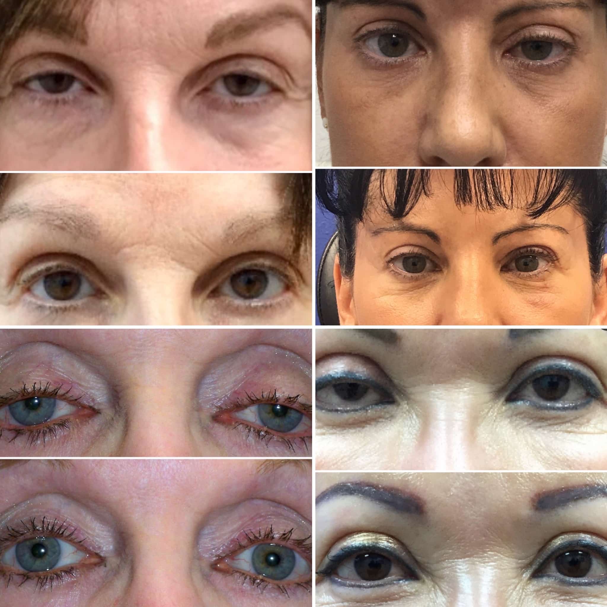 Fixing Botched Eyelid Surgery San Diego Eyelid Specialists