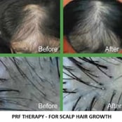 PRF Hair Restoration - San Diego Eyelid Specialists