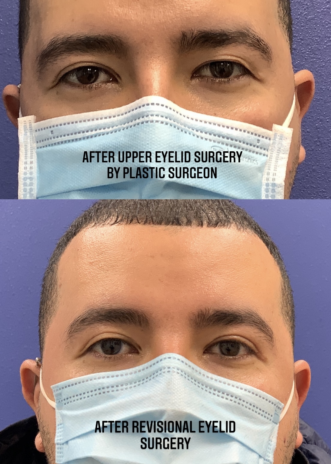Fixing Botched Eyelid Surgery