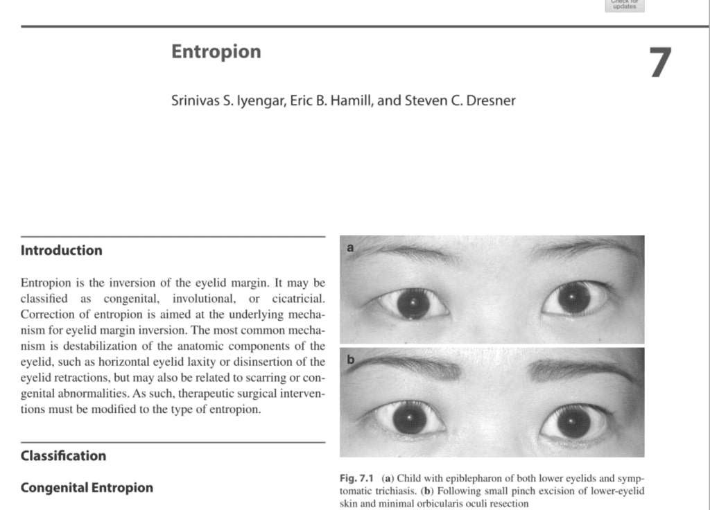 Dr. Iyengar’ chapter in eyelid surgery textbook