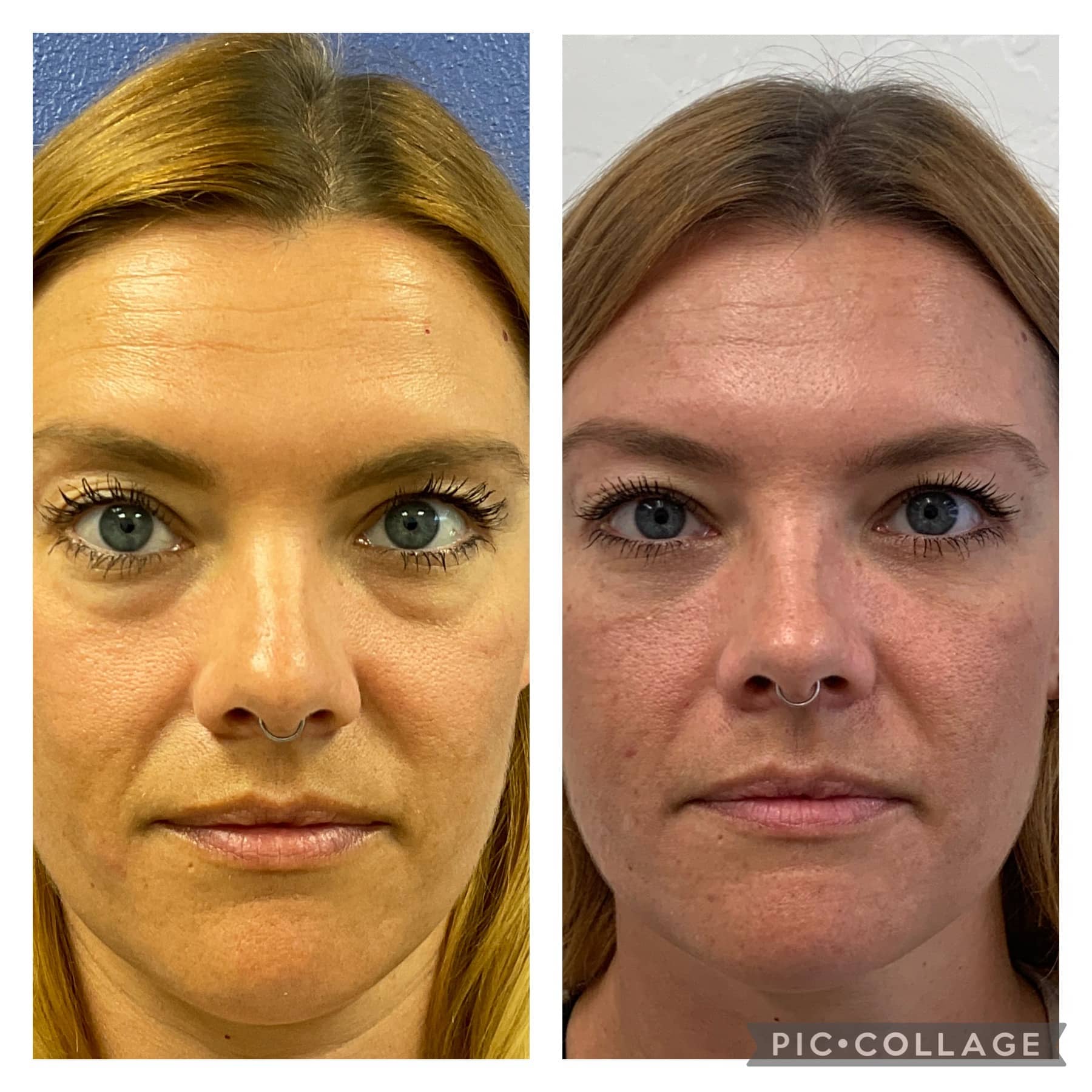 before and after scarless lower eyelid blepharoplasty