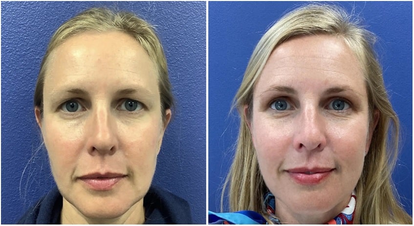 Upper eyelid deals blepharoplasty