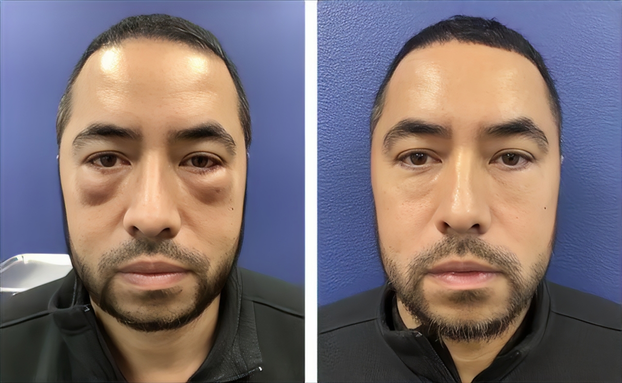 100672 fattransfer before and after rev.jpg